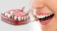 Implant Gigi Indramayu Implant Gigi Indramayu