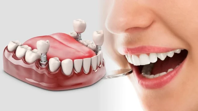 Implant Gigi Indramayu